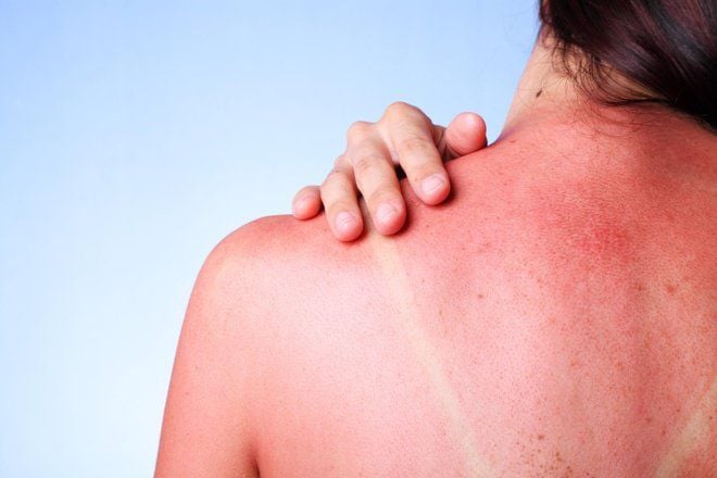 Da bị cháy nắng có trắng lại được không? Cách phục hồi